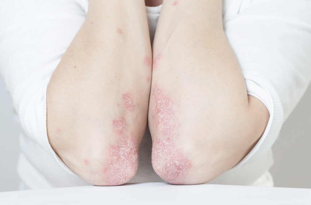 Patient advisory board for psoriatic arthritis trial design